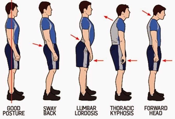 Back exercises can be used to correct poor posture.